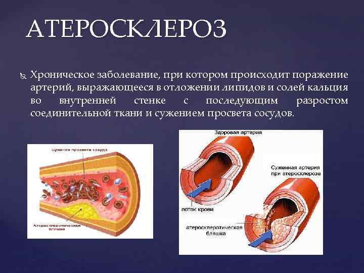 АТЕРОСКЛЕРОЗ Хроническое заболевание, при котором происходит поражение артерий, выражающееся в отложении липидов и солей