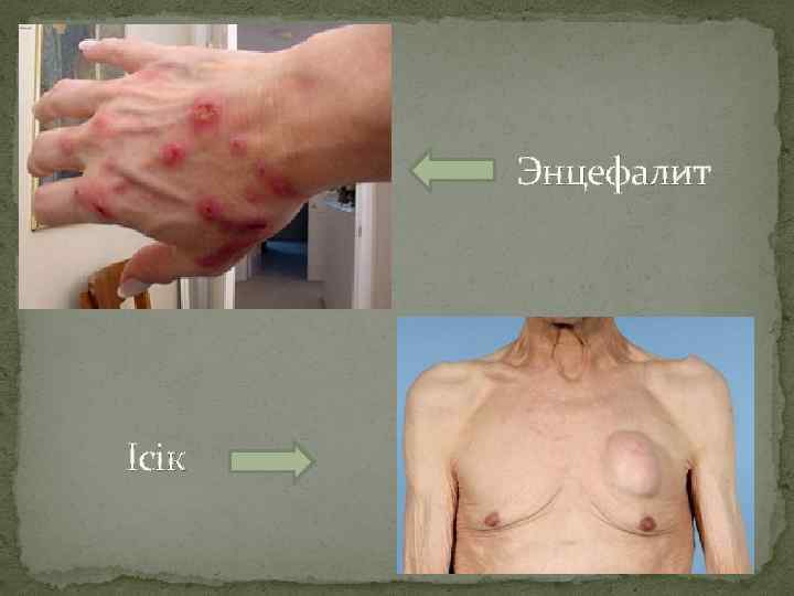 Энцефалит Ісік 