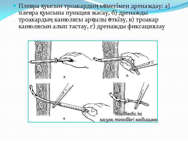  Плевра қуысын троакардың көмегімен дренаждау: а) плевра қуысына пункция жасау, б) дренажды троакардың