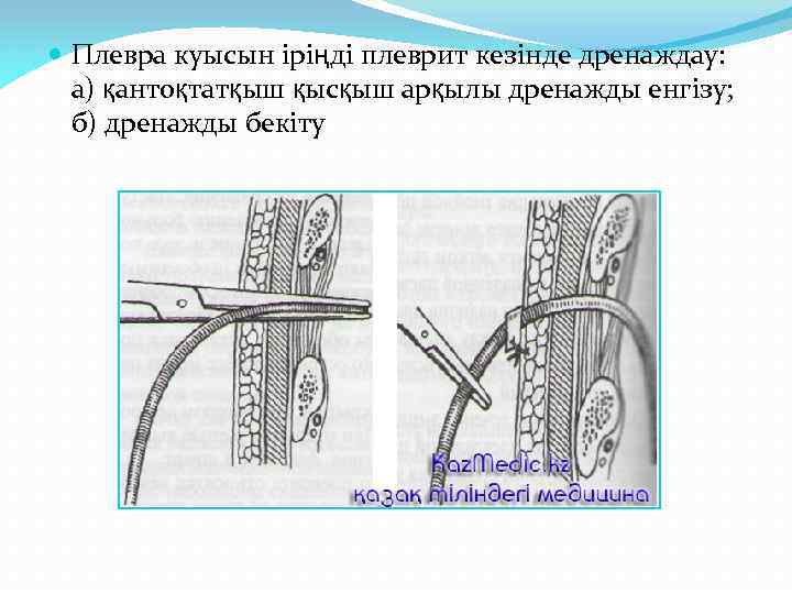  Плевра куысын іріңді плеврит кезінде дренаждау: а) қантоқтатқыш қысқыш арқылы дренажды енгізу; б)