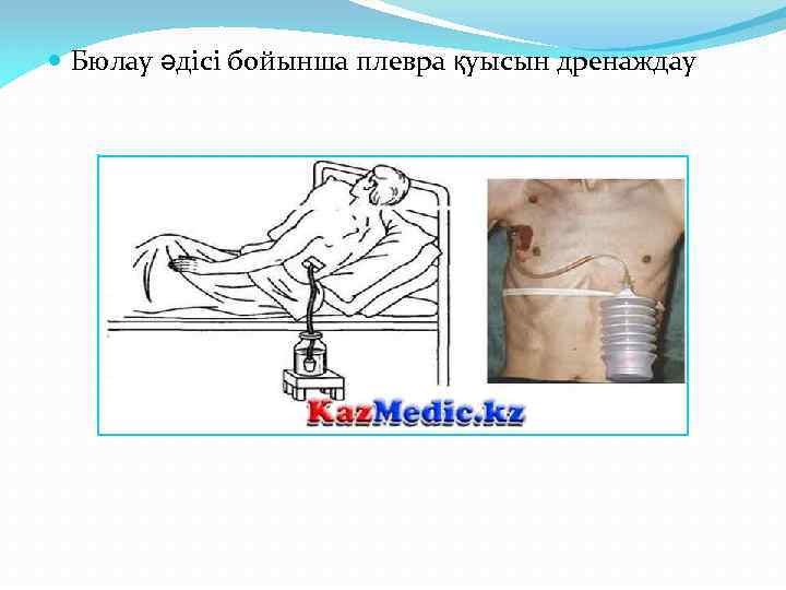  Бюлау әдісі бойынша плевра қуысын дренаждау 
