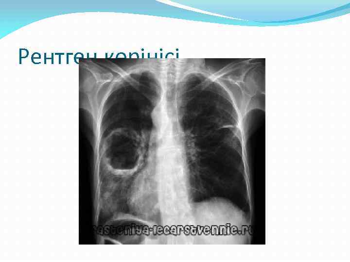 Рентген көрінісі 