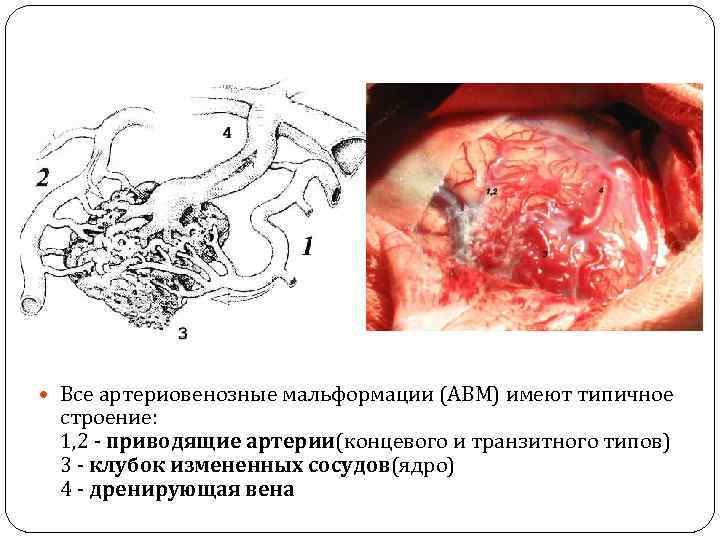  Все артериовенозные мальформации (АВМ) имеют типичное строение: 1, 2 - приводящие артерии(концевого и