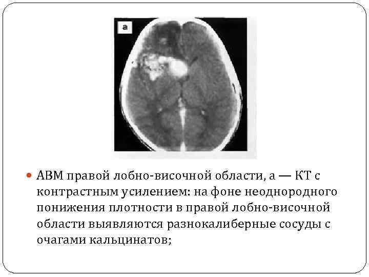  АВМ правой лобно-височной области, а — КТ с контрастным усилением: на фоне неоднородного
