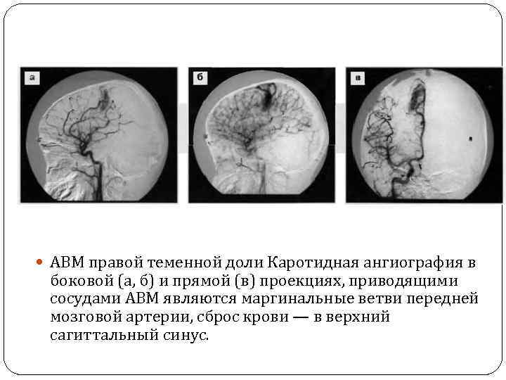  АВМ правой теменной доли Каротидная ангиография в боковой (а, б) и прямой (в)