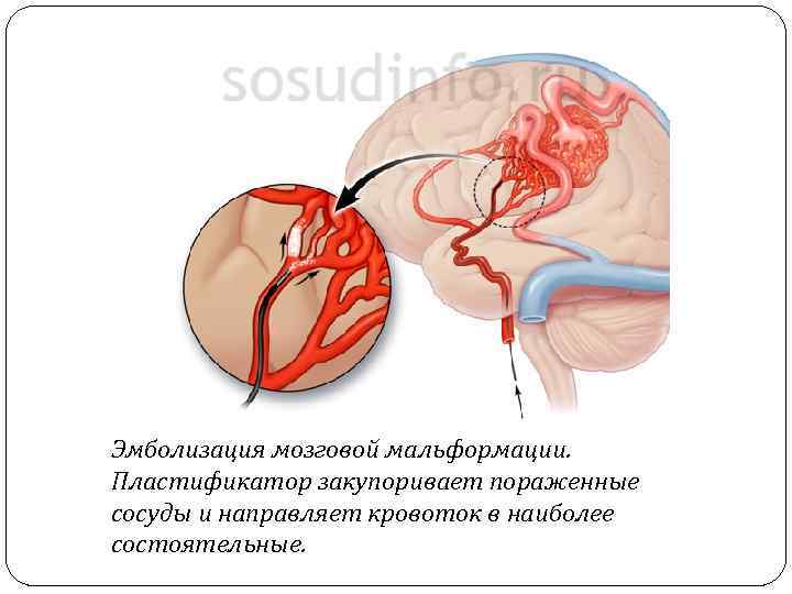 Эмболизация мозговой мальформации. Пластификатор закупоривает пораженные сосуды и направляет кровоток в наиболее состоятельные. 