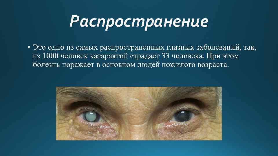 Распространение • Это одно из самых распространенных глазных заболеваний, так, из 1000 человек катарактой