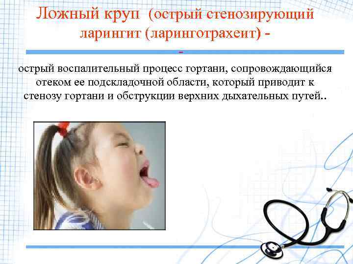 Ложный круп (острый стенозирующий ларингит (ларинготрахеит) острый воспалительный процесс гортани, сопровождающийся отеком ее подскладочной