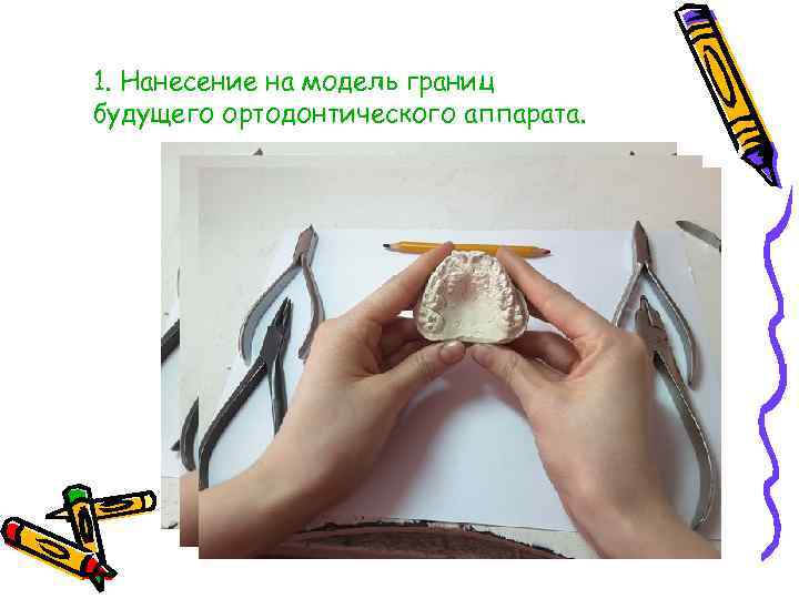 1. Нанесение на модель границ будущего ортодонтического аппарата. 
