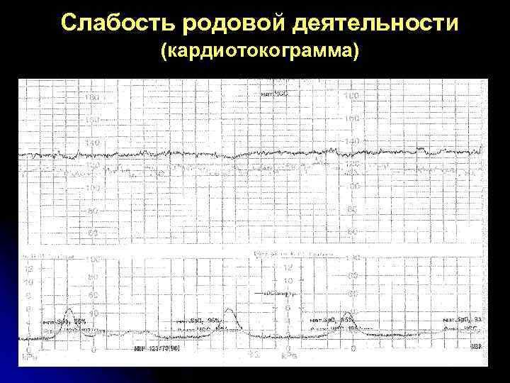 Слабость родовой деятельности (кардиотокограмма) 