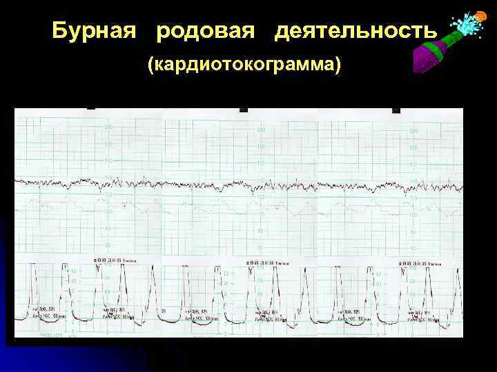 Бурная родовая деятельность (кардиотокограмма) 