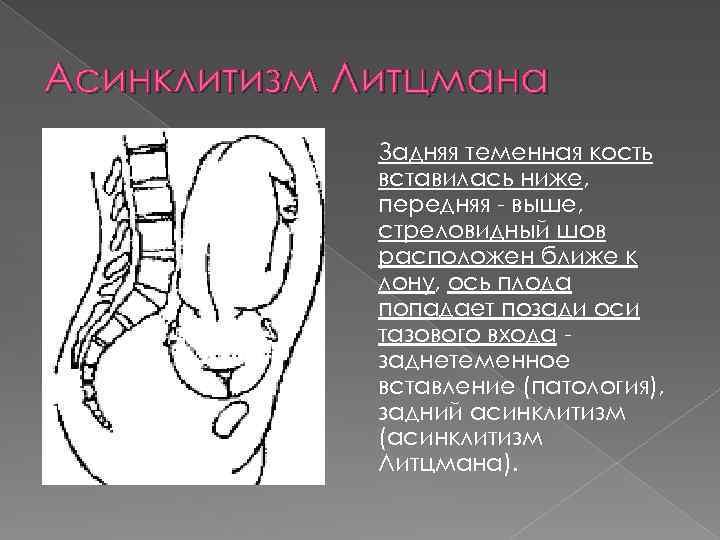 Асинклитизм Литцмана Задняя теменная кость вставилась ниже, передняя - выше, стреловидный шов расположен ближе