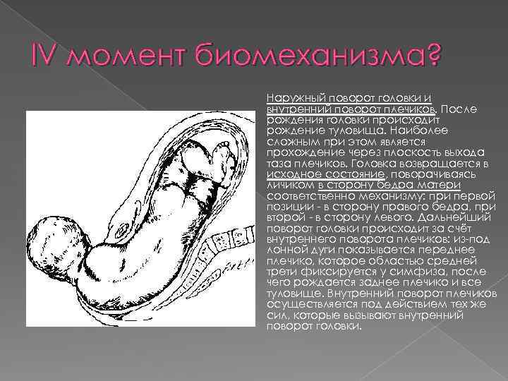 IV момент биомеханизма? Наружный поворот головки и внутренний поворот плечиков. После рождения головки происходит