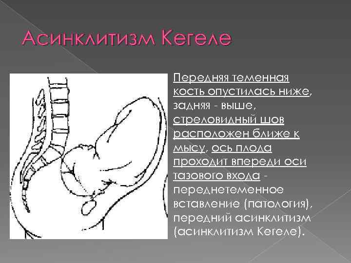 Асинклитизм Кегеле Передняя теменная кость опустилась ниже, задняя - выше, стреловидный шов расположен ближе