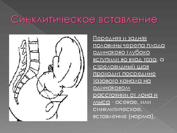 Синклитическое вставление Передняя и задняя половины черепа плода одинаково глубоко вступили во вход таза,