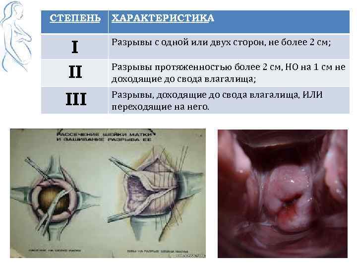СТЕПЕНЬ ХАРАКТЕРИСТИКА I II Разрывы с одной или двух сторон, не более 2 см;
