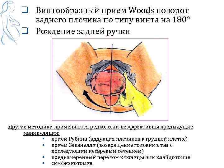 q Винтообразный прием Woods поворот заднего плечика по типу винта на 180° q Рождение