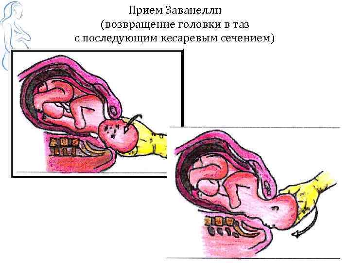 Прием Заванелли (возвращение головки в таз с последующим кесаревым сечением) 
