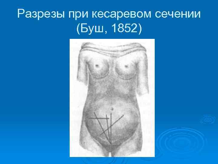 Разрезы при кесаревом сечении (Буш, 1852) 