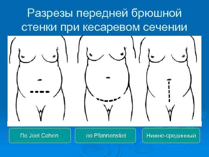 Разрезы передней брюшной стенки при кесаревом сечении По Joel Cohen по Pfannenstiel Нижне срединный
