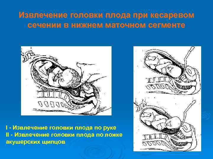 Для клинической картины перитонита после операции кесарева сечения на фоне хориоамнионита характерно