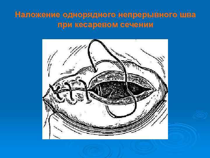 Наложение однорядного непрерывного шва при кесаревом сечении 