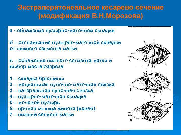 Экстраперитонеальное кесарево сечение (модификация В. Н. Морозова) а - обнажение пузырно-маточной складки б –