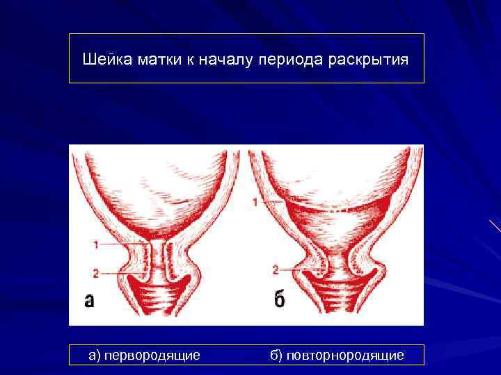 Шейка матки к началу периода раскрытия а) первородящие б) повторнородящие 
