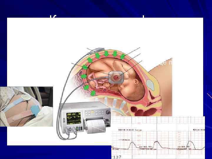 Кардиотокография Датчик тонуса матки Датчик сердцебиения плода Тонус матки Стенка матки Сердце плода 