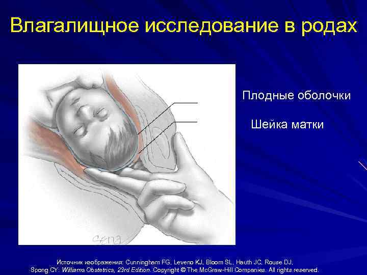 Плодный пузырь. Влагалищное исследование. Вагинальное исследование в родах. Влагалищное исследование при беременности. Влагалищное исследование роды.