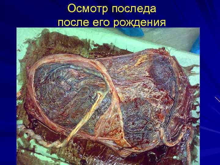 Осмотр последа после его рождения 