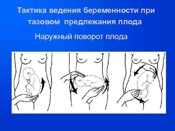 Тактика ведения беременности при тазовом предлежания плода Наружный поворот плода 