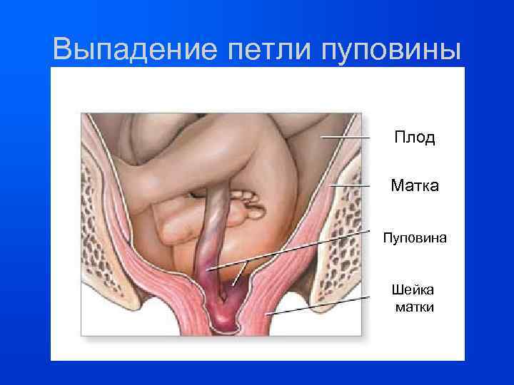 Выпадение петли пуповины Плод Матка Пуповина Шейка матки 