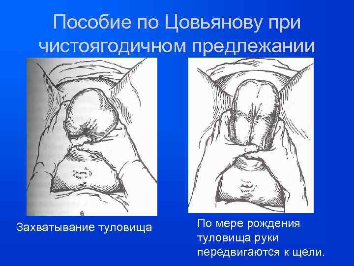 Пособие по Цовьянову при чистоягодичном предлежании Захватывание туловища По мере рождения туловища руки передвигаются