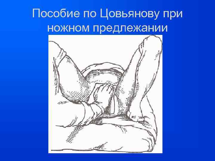 Пособие по Цовьянову при ножном предлежании 