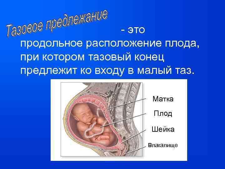 - это продольное расположение плода, при котором тазовый конец предлежит ко входу в малый