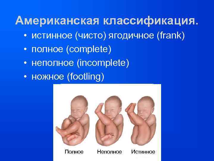 Американская классификация. • • истинное (чисто) ягодичное (frank) полное (complete) неполное (incomplete) ножное (footling)