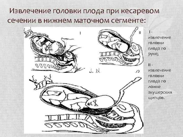 Извлечение головки плода при кесаревом сечении в нижнем маточном сегменте: I извлечение головки плода
