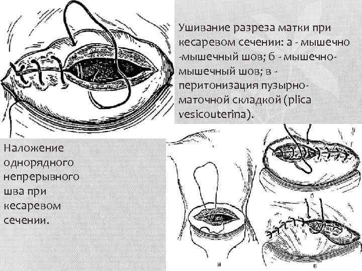 Истмико корпоральный разрез на матке рисунок