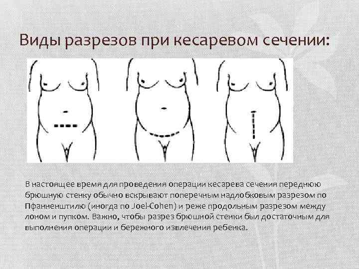 Виды разрезов при кесаревом сечении: В настоящее время для проведения операции кесарева сечения переднюю