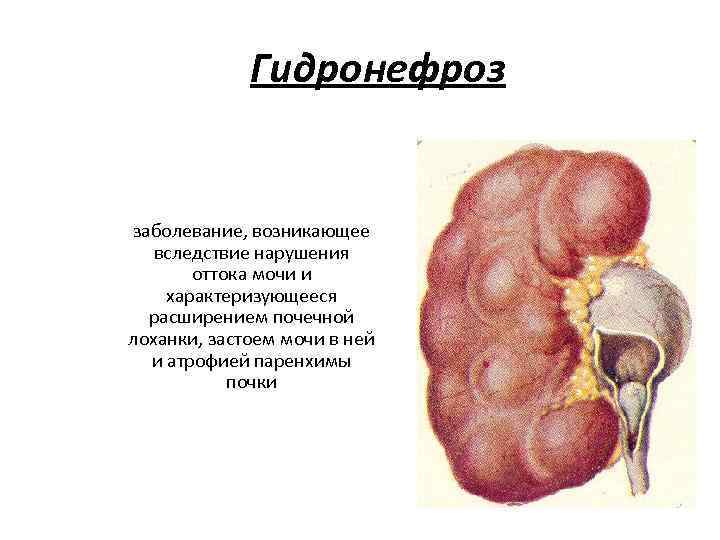 Вследствие болезни возникли. Строение почки гидронефроз анатомия. Гидронефроз почек клинические рекомендации. Почка воспаление гидронефроз. Гидронефроз почки макропрепарат.