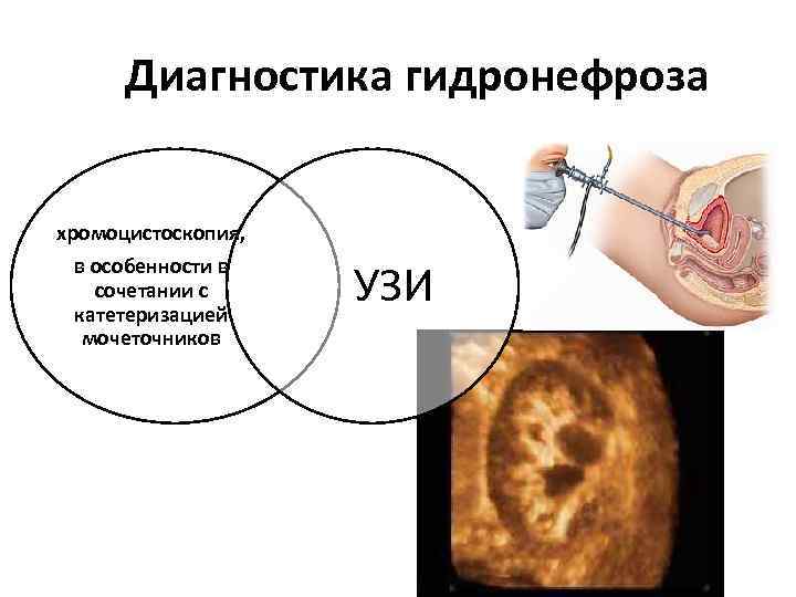 Диагностика гидронефроза хромоцистоскопия, в особенности в сочетании с катетеризацией мочеточников УЗИ 