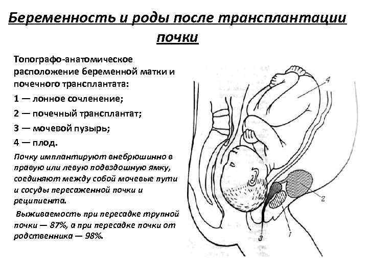 Беременность и роды после трансплантации почки Топографо-анатомическое расположение беременной матки и почечного трансплантата: 1