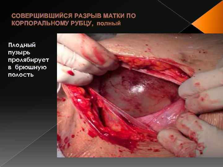 СОВЕРШИВШИЙСЯ РАЗРЫВ МАТКИ ПО КОРПОРАЛЬНОМУ РУБЦУ, полный Плодный пузырь пролябирует в брюшную полость 