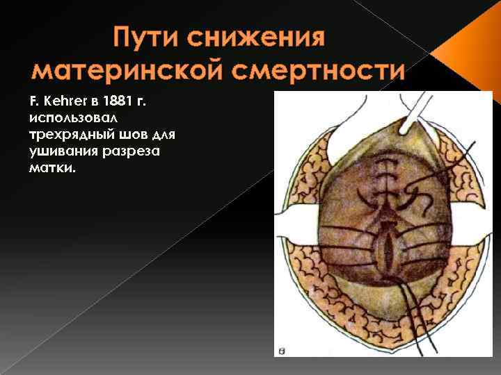 Пути снижения материнской смертности F. Kehrer в 1881 г. использовал трехрядный шов для ушивания