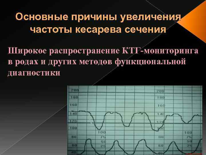 Основные причины увеличения частоты кесарева сечения Широкое распространение КТГ-мониторинга в родах и других методов