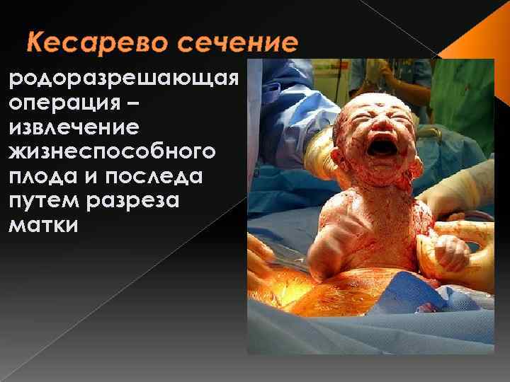 Кесарево сечение родоразрешающая операция – извлечение жизнеспособного плода и последа путем разреза матки 