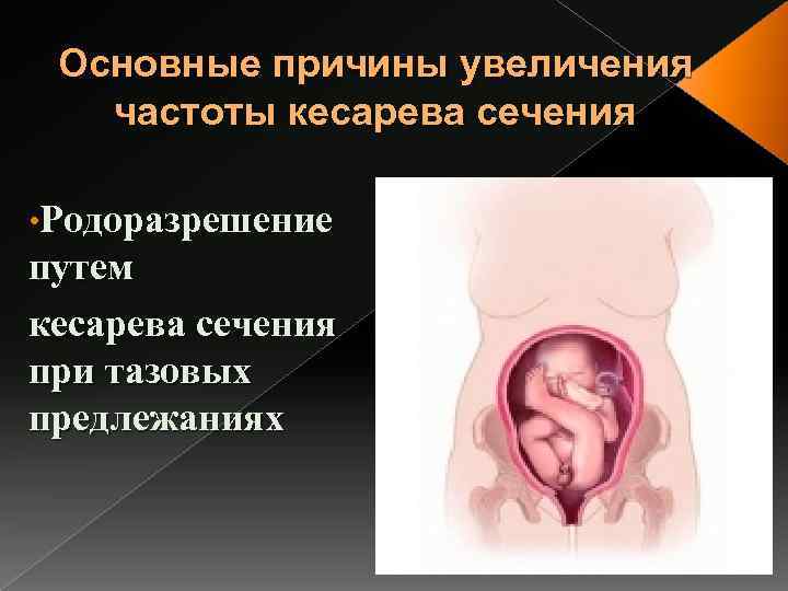 Основные причины увеличения частоты кесарева сечения • Родоразрешение путем кесарева сечения при тазовых предлежаниях