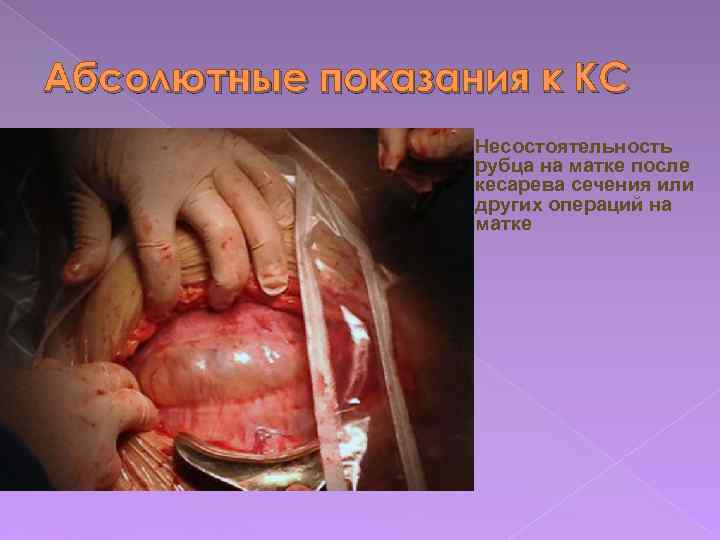 Абсолютные показания к КС Несостоятельность рубца на матке после кесарева сечения или других операций