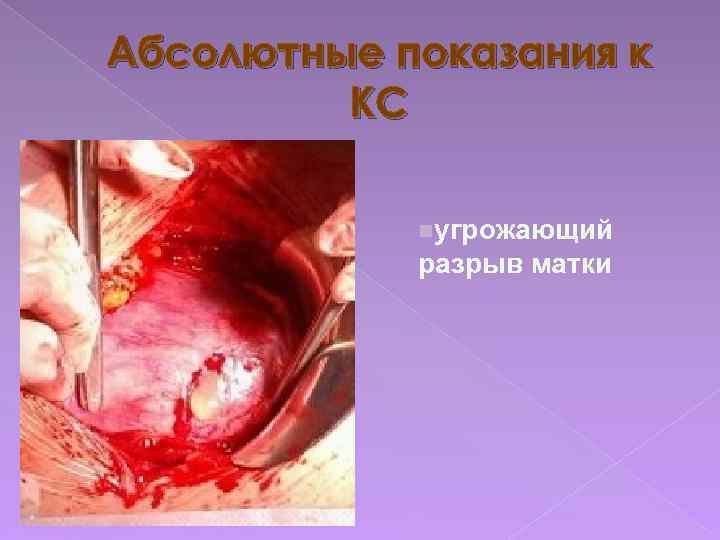 Абсолютные показания к КС nугрожающий разрыв матки 